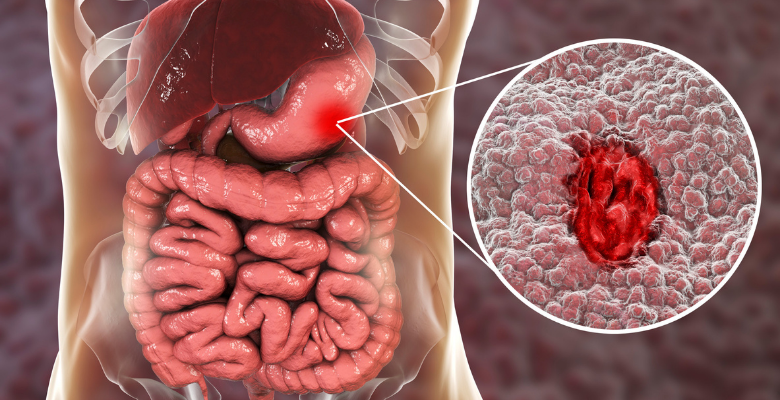 ULS de Almada-Seixal estuda alterações na mucosa gástrica relacionadas à idade