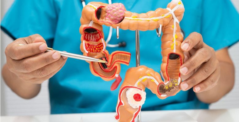 Rastreio do cancro colorretal: atrasos no acompanhamento após teste positivo em Portugal