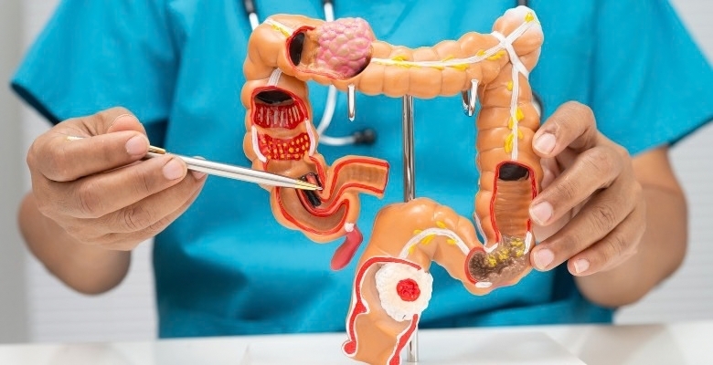Nanotecnologia e lipossomas podem abrir novas frentes no tratamento do cancro colorretal